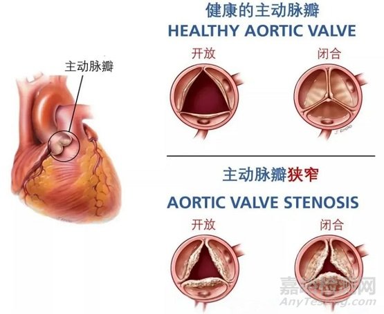 以心醫(yī)療創(chuàng)新醫(yī)械經(jīng)導(dǎo)管主動脈瓣系統(tǒng)技術(shù)解析