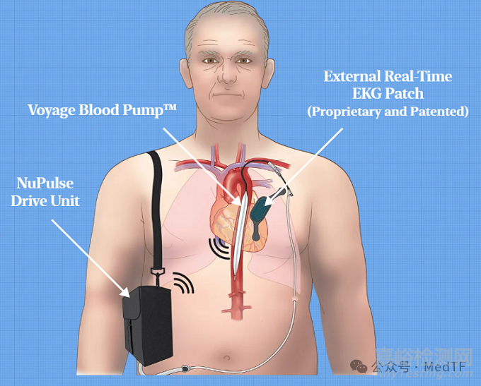 【創(chuàng)新醫(yī)械】voyage：可穿戴主動(dòng)脈反博球囊，僅重4.5斤
