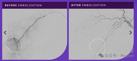 Embrace HES:水凝膠血管栓塞劑獲FDA批準(zhǔn)