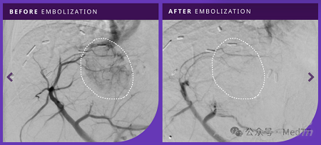 Embrace HES:水凝膠血管栓塞劑獲FDA批準(zhǔn)