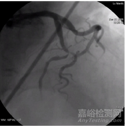 先瑞達自主研發(fā)的西羅莫司藥物涂層冠脈球囊擴張導管技術解析