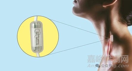 【創(chuàng)新醫(yī)械】SetPoint：小型神經(jīng)刺激器，降低炎癥水平