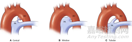 先健科技創(chuàng)新醫(yī)械鎳鈦合金動(dòng)脈導(dǎo)管未閉封堵器技術(shù)解析