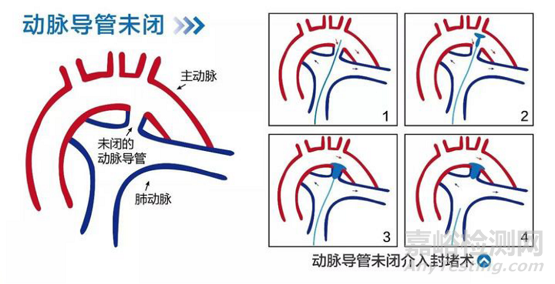 先健科技創(chuàng)新醫(yī)械鎳鈦合金動(dòng)脈導(dǎo)管未閉封堵器技術(shù)解析