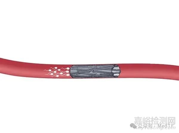 【創(chuàng)新醫(yī)械】Proventis：長效可靠且可逆的男性避孕支架