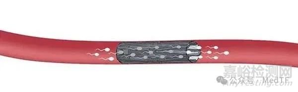 【創(chuàng)新醫(yī)械】Proventis：長效可靠且可逆的男性避孕支架