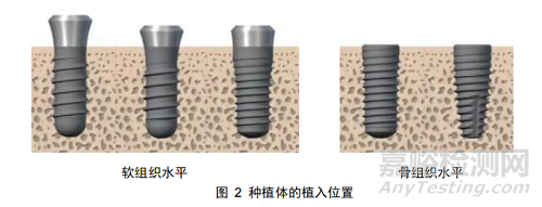 《牙科種植體系統(tǒng)生產(chǎn)環(huán)節(jié)風(fēng)險清單和檢查指南》