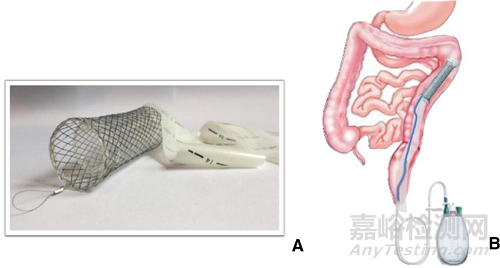 Colovac:健適醫(yī)療支持的吻合口漏解決方案獲批上市