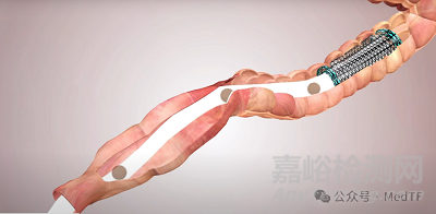 Colovac:健適醫(yī)療支持的吻合口漏解決方案獲批上市