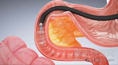【創(chuàng)新醫(yī)械】RFVA:射頻蒸汽消融治療糖尿病