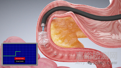【創(chuàng)新醫(yī)械】RFVA:射頻蒸汽消融治療糖尿病