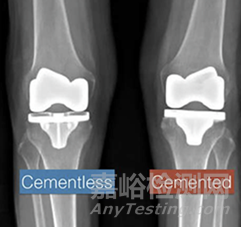 無骨水泥膝關(guān)節(jié)假體技術(shù)臨床應(yīng)用激增