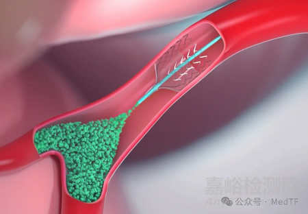 【創(chuàng)新醫(yī)械】ECORE:帶覆膜支架的栓塞微導(dǎo)管