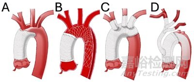 主動脈修復(fù)醫(yī)療器械技術(shù)、產(chǎn)品與市場分析