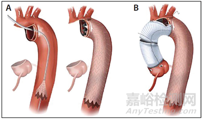 主動脈修復(fù)醫(yī)療器械技術(shù)、產(chǎn)品與市場分析