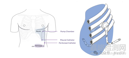 【創(chuàng)新醫(yī)械】ACES：完全可植入自動引流的胸腔引流管，胸腔積液引流至腹腔