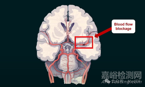 【創(chuàng)新醫(yī)械】TRAP：帶“牙齒”的抽吸導(dǎo)管，取栓成功率提高300%