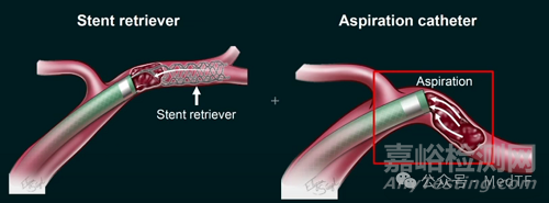 【創(chuàng)新醫(yī)械】TRAP：帶“牙齒”的抽吸導(dǎo)管，取栓成功率提高300%
