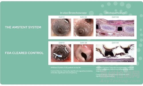 全球首個(gè)采用脫細(xì)胞羊膜覆蓋的氣管支架獲批上市