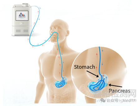 Arctx Cool Catheter：急性胰腺炎無創(chuàng)冷凍療法