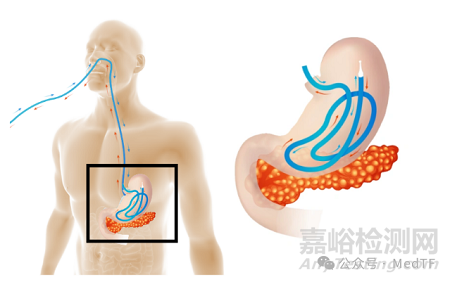 Arctx Cool Catheter：急性胰腺炎無創(chuàng)冷凍療法