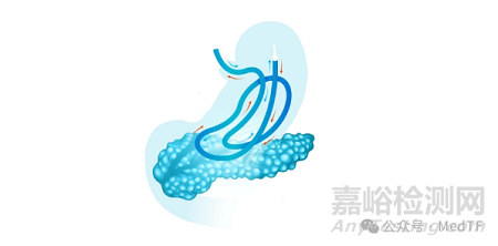 Arctx Cool Catheter：急性胰腺炎無創(chuàng)冷凍療法