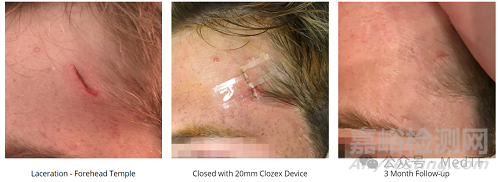 【創(chuàng)新醫(yī)械】Clozex：能縫合傷口的膠帶，無需縫線