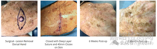 【創(chuàng)新醫(yī)械】Clozex：能縫合傷口的膠帶，無需縫線