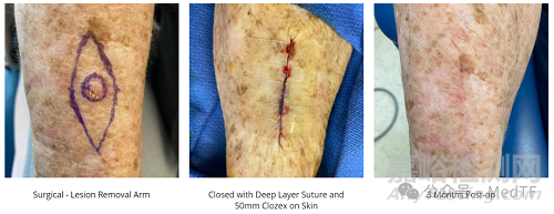 【創(chuàng)新醫(yī)械】Clozex：能縫合傷口的膠帶，無需縫線