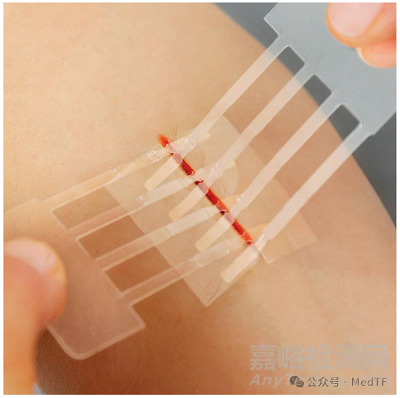 【創(chuàng)新醫(yī)械】Clozex：能縫合傷口的膠帶，無需縫線