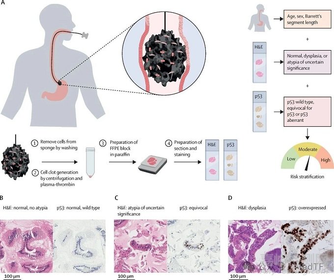 【創(chuàng)新醫(yī)械】EndoSign:食管癌檢測膠囊