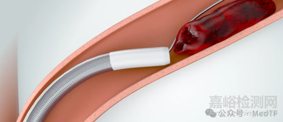 FDA批準首款大口徑連續(xù)真空抽吸導管，治療肺栓塞