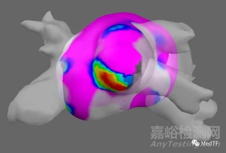 全球唯一集成高密度標測的PFA消融導管獲批FDA