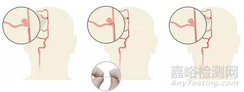 全球首款0.024英寸可操控導(dǎo)絲獲批上市