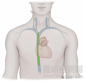 【創(chuàng)新醫(yī)械】VQ Catheter：血管內(nèi)氧合導管，血管內(nèi)氣體交換的ECMO