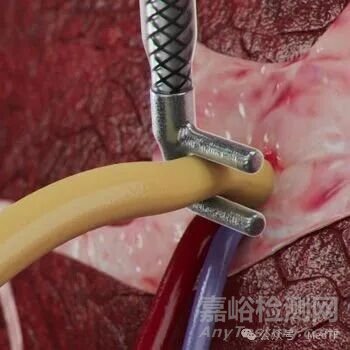 【創(chuàng)新醫(yī)械】cryoXT：治療疼痛的冷凍消融“夾”獲批FDA，技術(shù)源于電生理