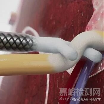 【創(chuàng)新醫(yī)械】cryoXT：治療疼痛的冷凍消融“夾”獲批FDA，技術(shù)源于電生理