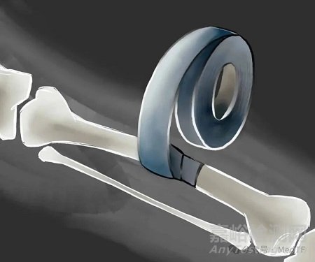【創(chuàng)新醫(yī)械】BoneTape：治療骨折“創(chuàng)可貼” ，取代骨釘骨板