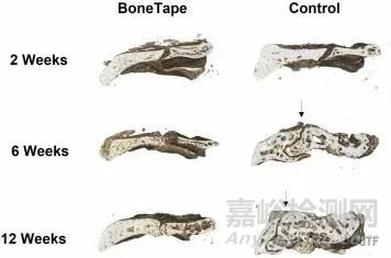 【創(chuàng)新醫(yī)械】BoneTape：治療骨折“創(chuàng)可貼” ，取代骨釘骨板