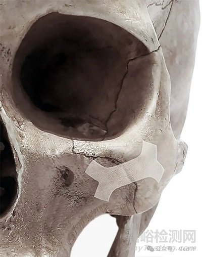 【創(chuàng)新醫(yī)械】BoneTape：治療骨折“創(chuàng)可貼” ，取代骨釘骨板