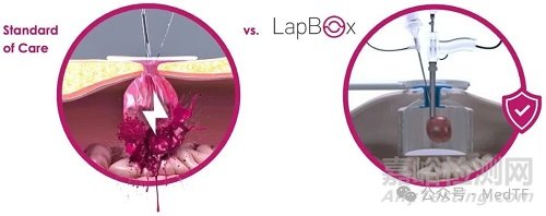 【創(chuàng)新醫(yī)械】LapBox POWER :腫瘤組織粉碎保護(hù)器