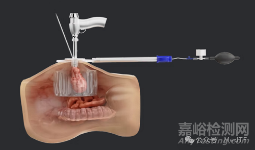 【創(chuàng)新醫(yī)械】LapBox POWER :腫瘤組織粉碎保護(hù)器