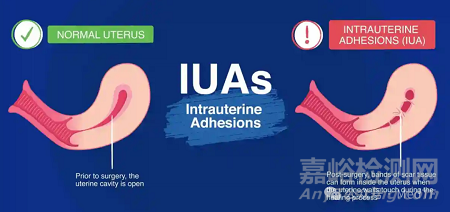 Womed Leaf：FDA批準(zhǔn)首款解決宮腔粘連的可降解薄膜