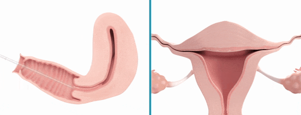Womed Leaf：FDA批準(zhǔn)首款解決宮腔粘連的可降解薄膜
