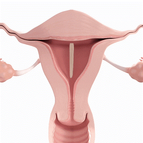 Womed Leaf：FDA批準(zhǔn)首款解決宮腔粘連的可降解薄膜