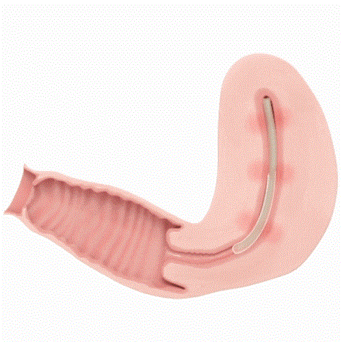 Womed Leaf：FDA批準(zhǔn)首款解決宮腔粘連的可降解薄膜