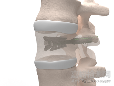 VCFix：首款可以取代骨水泥的椎體增強產(chǎn)品獲FDA批準(zhǔn)上市