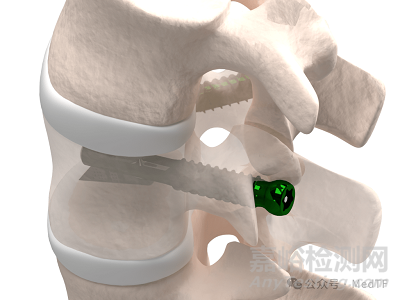 VCFix：首款可以取代骨水泥的椎體增強產(chǎn)品獲FDA批準(zhǔn)上市