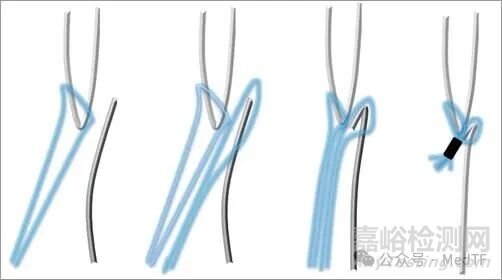 【創(chuàng)新醫(yī)械】NobleStitch卵圓孔縫合器，相比封堵器更安全