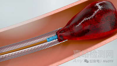 【創(chuàng)新醫(yī)械】Symphony大口徑連續(xù)真空抽吸導(dǎo)管，取栓后肺動(dòng)脈收縮壓平均降低12mmHg